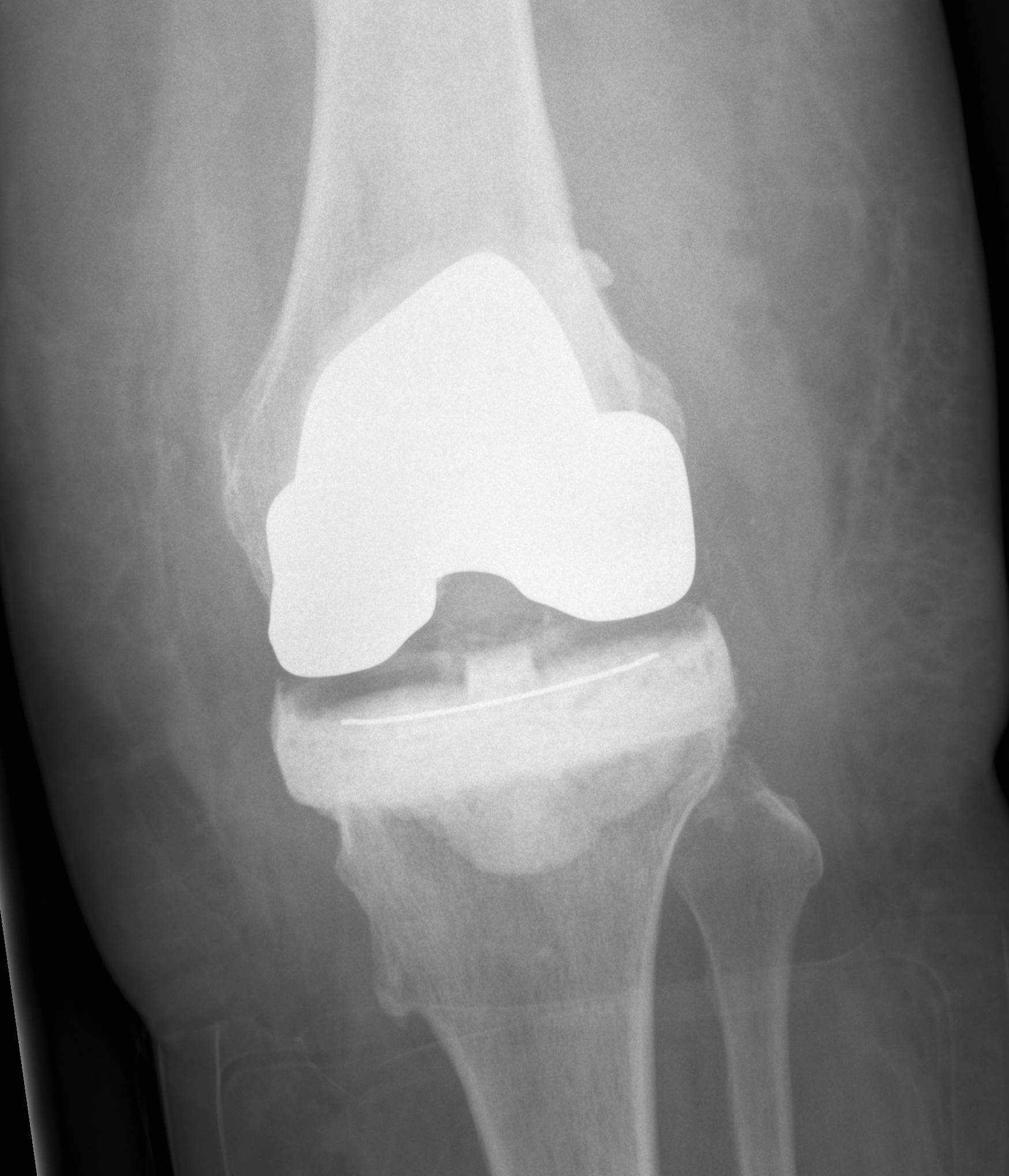 Infected TKR Autoclave Femur Cement Tibia AP